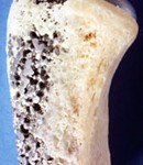 PROTESI INGLOBATA NEL FEMORE