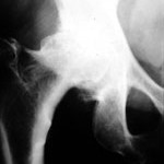 Radiografia anca artrosica