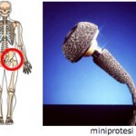protesi4
