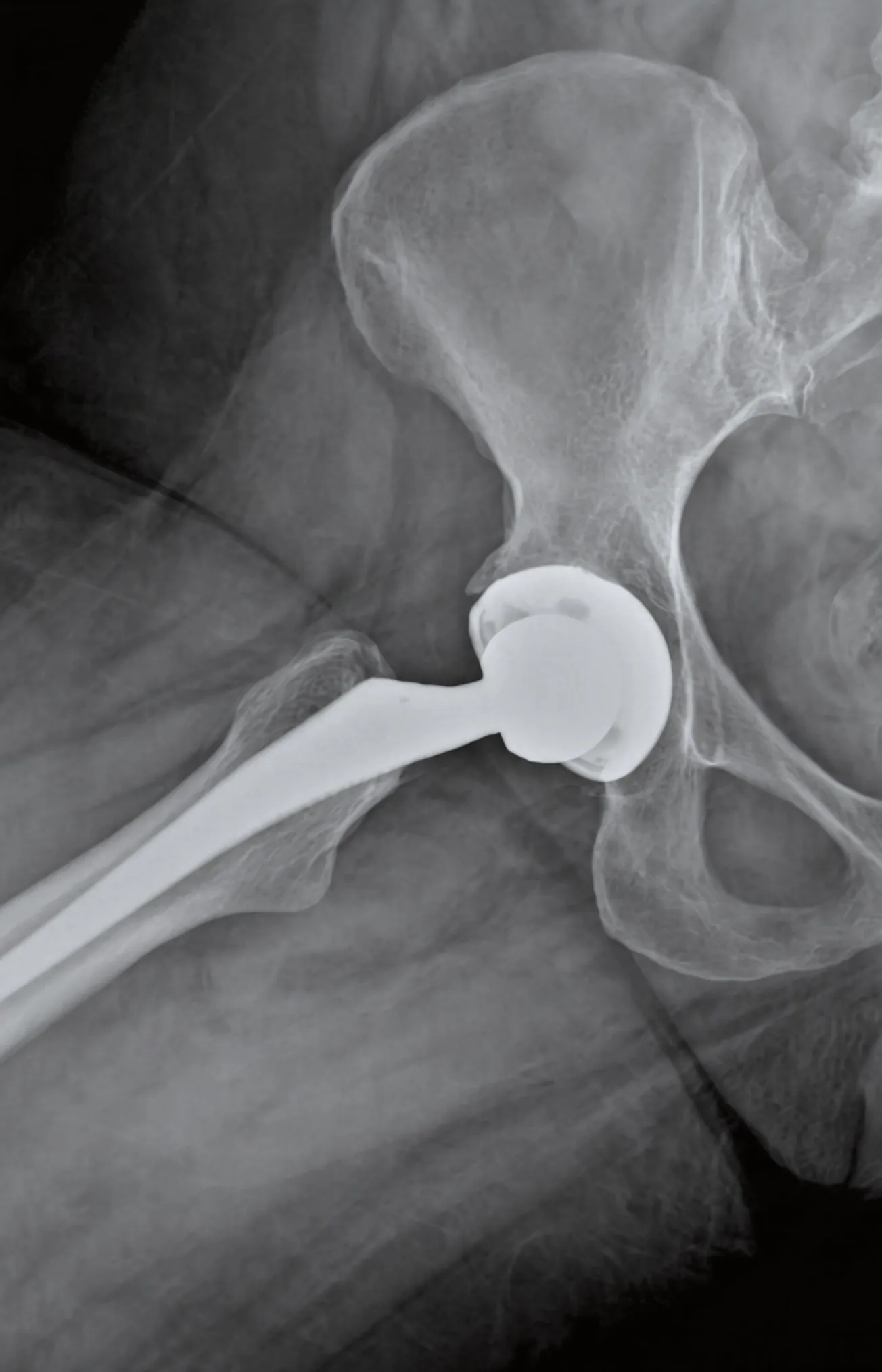 Orthopedic Hip Surgery
