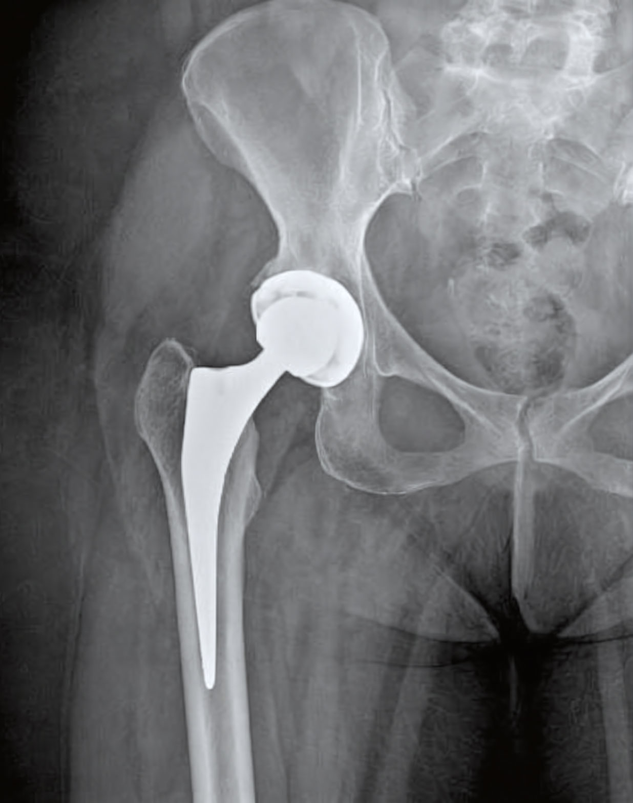 Hip Rehabilitation
